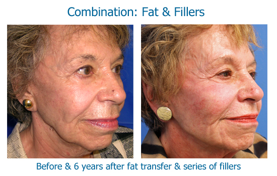 Facial Fat Grafting Archives Skinspirationsskinspirations 