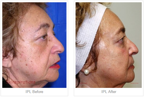 IPL Before - AFter