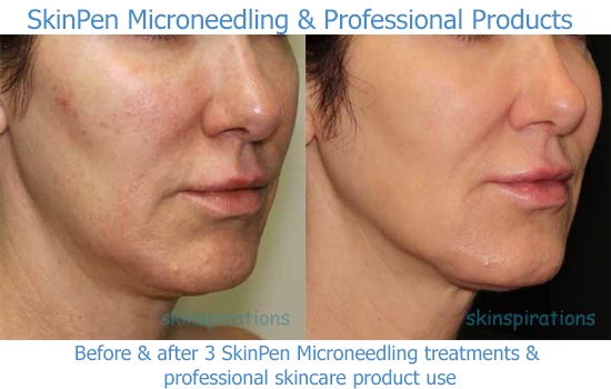 Skinpen_products_PM