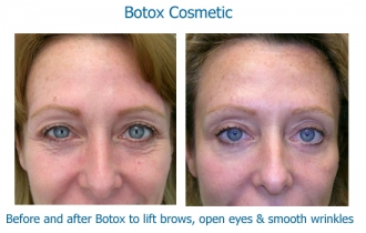Botox-eyes