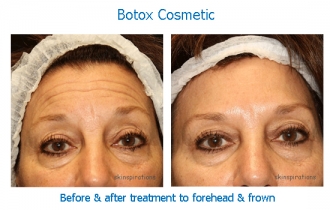 Botox forehead SV_edited-1