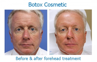 Botox-forehead_edited-1