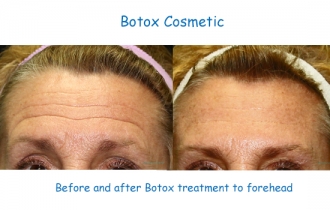 Botox_forehead_GlHu