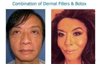 Combination fillers & botox
