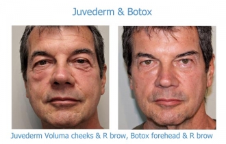 Juv and botox FO