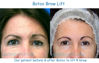 TOX_brow_SyMc