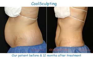 A thinner abdomen after CoolSculpting fat reduction