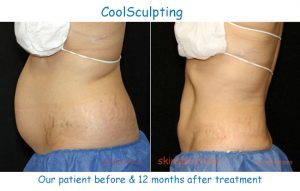 Ultrasonic Cavitation Tampa