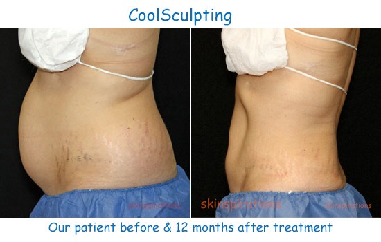 Photo showing a thinner abdomen after CoolSculpting fat reduction