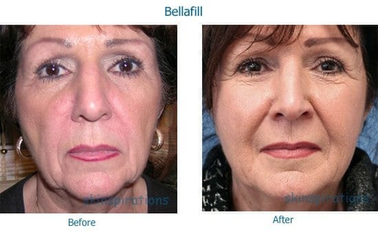Restoring facial volume with dermal filler