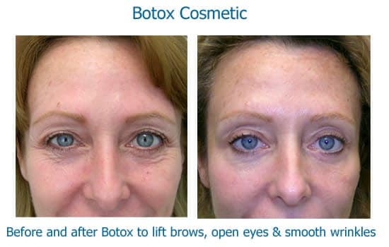 Botox to lift brows and smooth crows feet