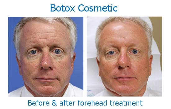 Man with Botox to forehead wrinkles