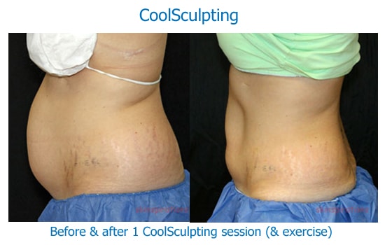 before and after photos of CoolSculpting results on woman's abdomen, in a profile view