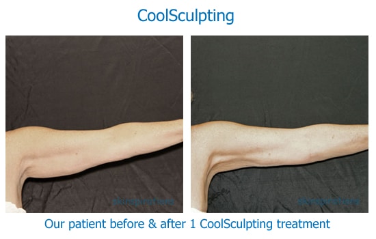 before and after photos of results of Coolsculpting fat reduction on the arms