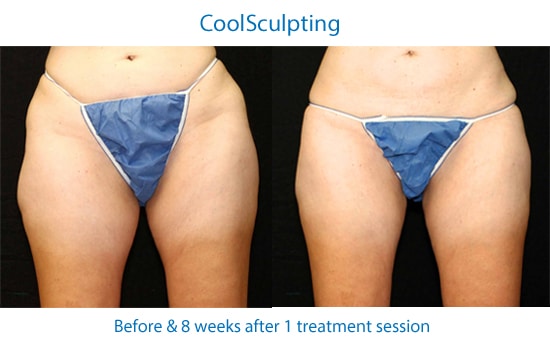 Thighs after coolsculpting fat removal