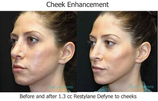 Before and after Restylane Defyne to cheeks