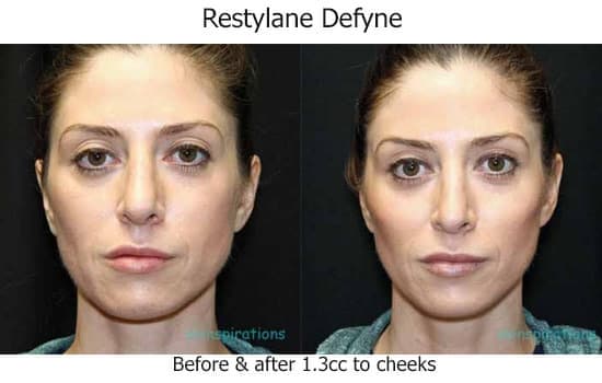 Before and after Restylane Defyne