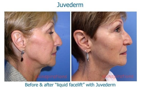 Tighter jaw with dermal filler