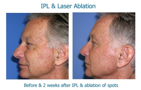 Man's face after brown spots removed with laser