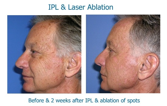 Man&#039;s face after brown spots removed with laser