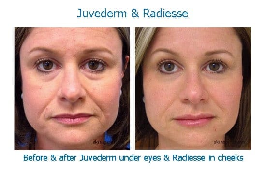 Dermal filler removes dark circles under eyes