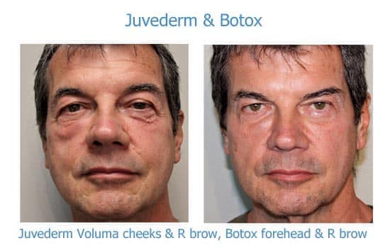 man looks more vibrant and rested after Botox and dermal filler