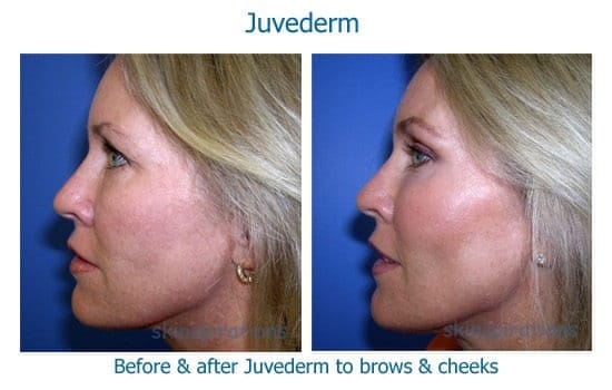 Brow lift &amp; cheek augmentation with dermal filler