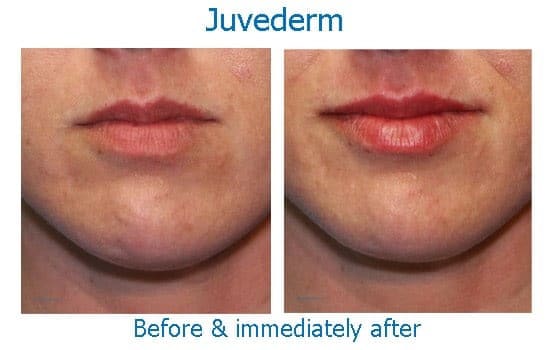 Before and after dermal filler to lips