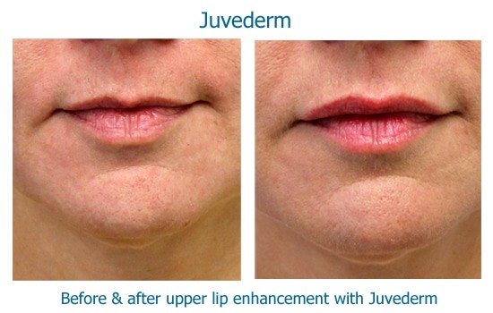 Before and after dermal filler lip enhancement