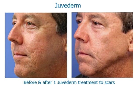 Before and after Juvederm for scars and wrinkles