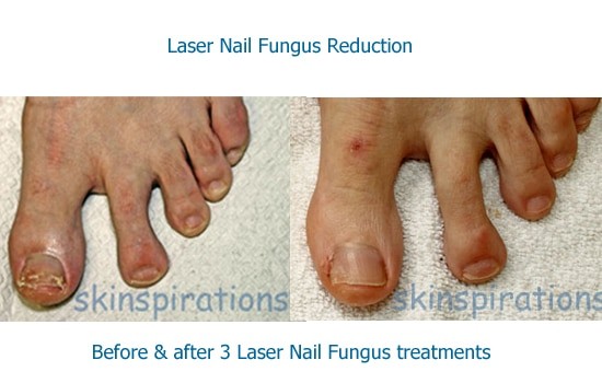 Laser toe nail fungus results