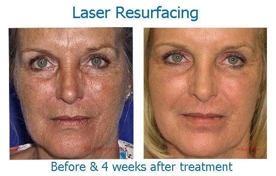 Results of laser resurfacing face