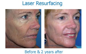 Before and after photos of full-field laser resurfacing to the face, at Skinspirations