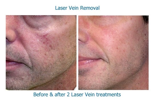 closeup photo of cheek before and after laser vein removal