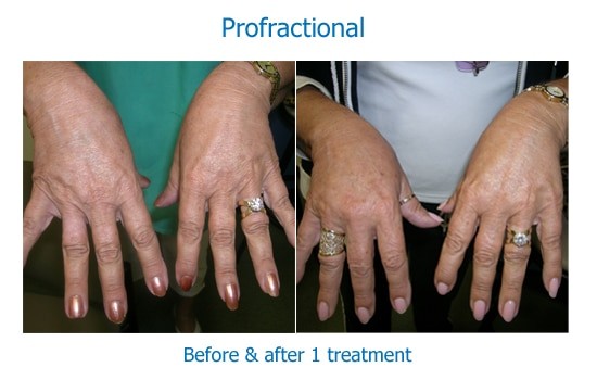 Fractionated laser treatment results on hands