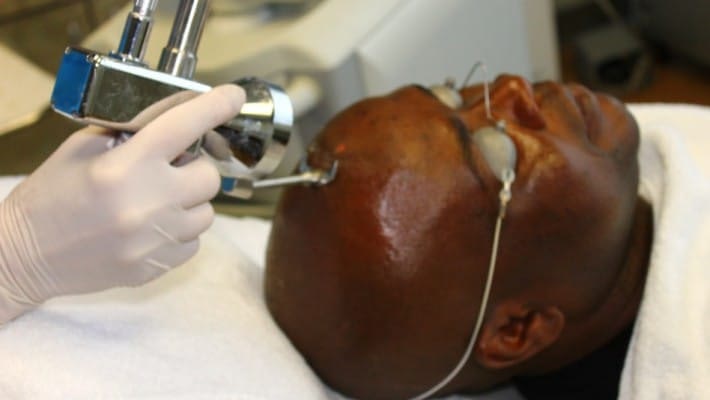 closeup of profractional laser treatment on a black man's scalp