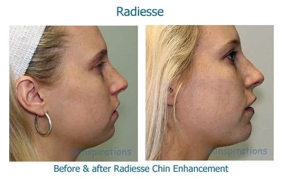Chin augmentation with dermal filler