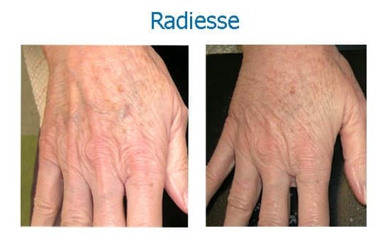 Before and after Radiesse to plump hands