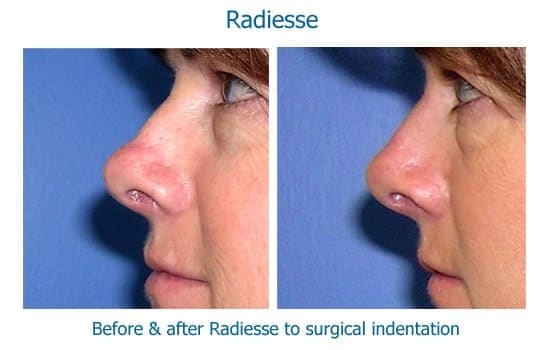nonsurgical rhinoplasty results