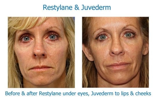 Before and after dermal fillers to eyes and lips