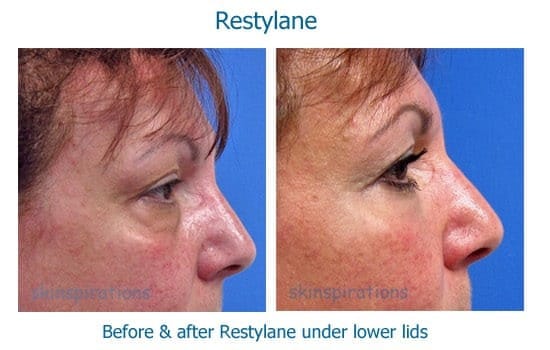 Before and after Restylane to treat eye bags