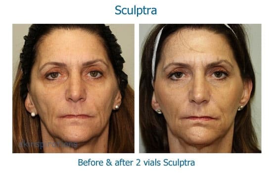 Before and after filling out a thin face with Sculptra