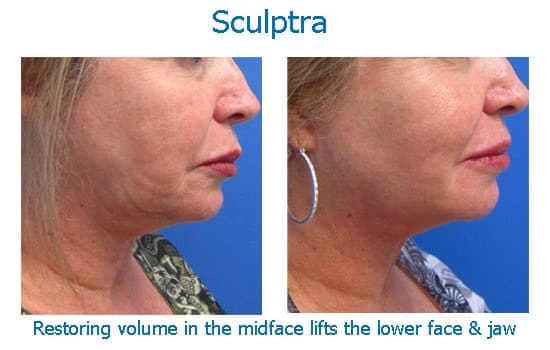 Sculptra makes jawline tighter