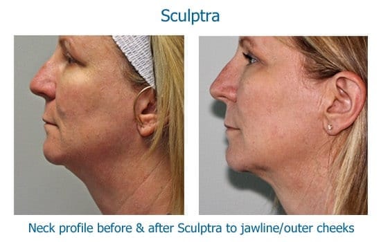 Before and after Sculptra to tighten neck