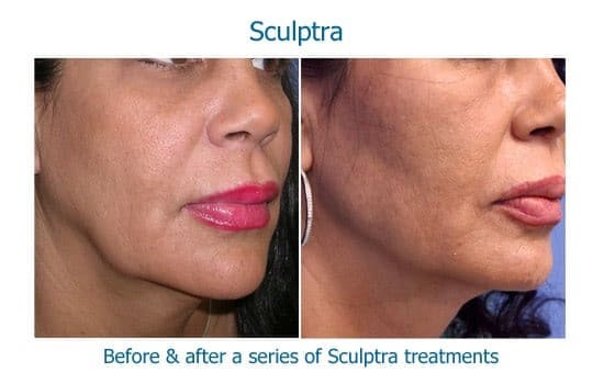 Before and after Sculptra to decrease jowling
