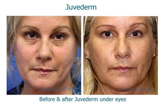 Before and after Juvederm to treat dark circles under eyes