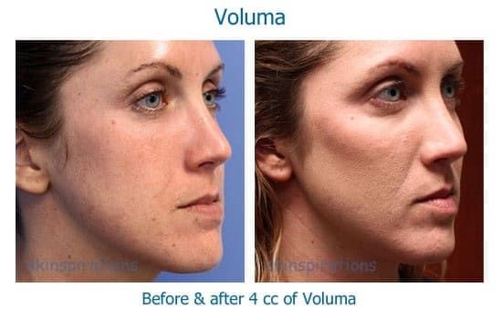 Young woman before and after Voluma to cheeks