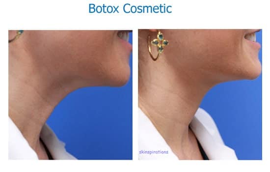 Botox to improve neck tightness