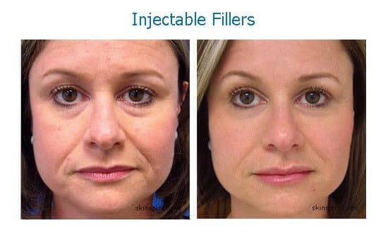 Dark circles under eyes treated with dermal filler