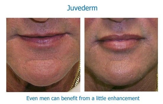 Before and after dermal filler lip enhancement in man